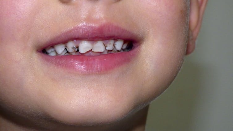 A child with dental carries smiling for his picture.