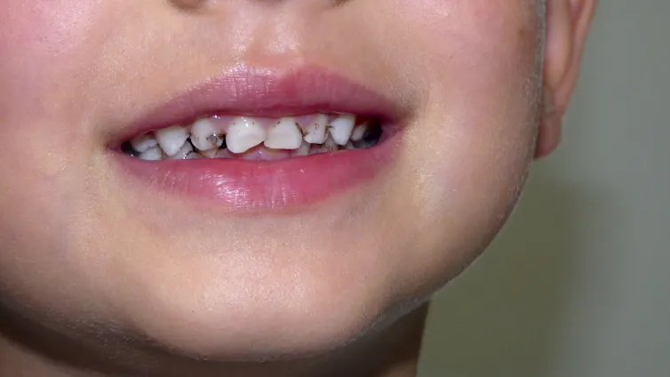 A child with dental carries smiling for his picture.