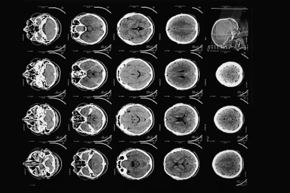 First Brain Ct Scan 50 years ago, the first CT scan let doctors see inside a living skull ...