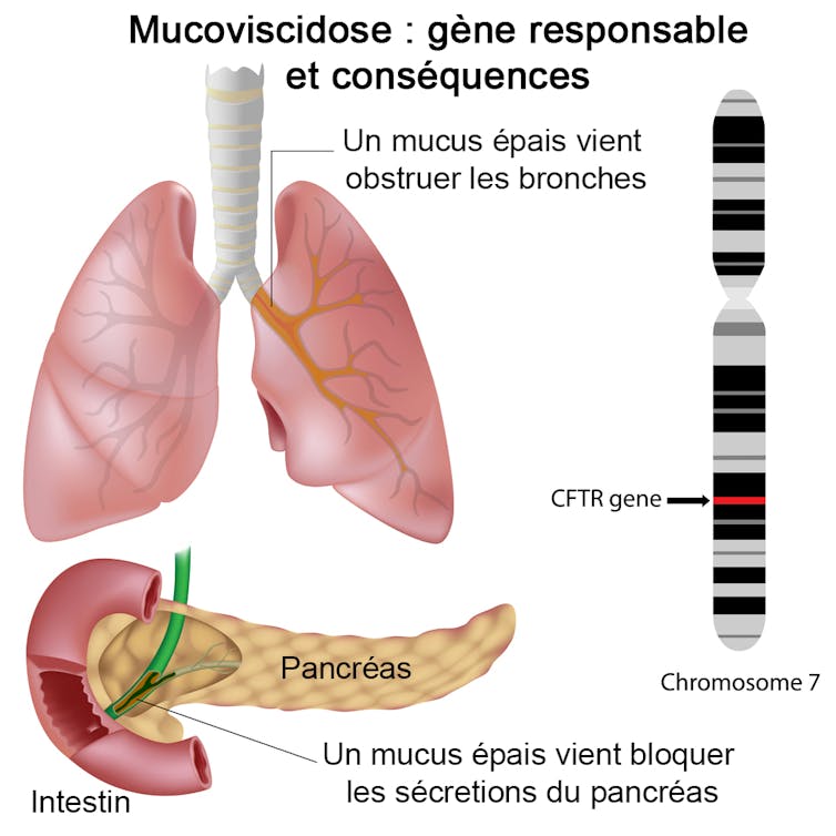 Localisation du gène CFTR et dessins montrant l’obstruction des bronches et des voies pancréatiques par le mucus