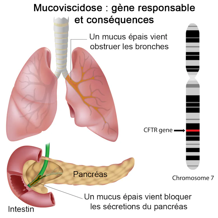 Localisation du gène CFTR et dessins montrant l’obstruction des bronches et des voies pancréatiques par le mucus