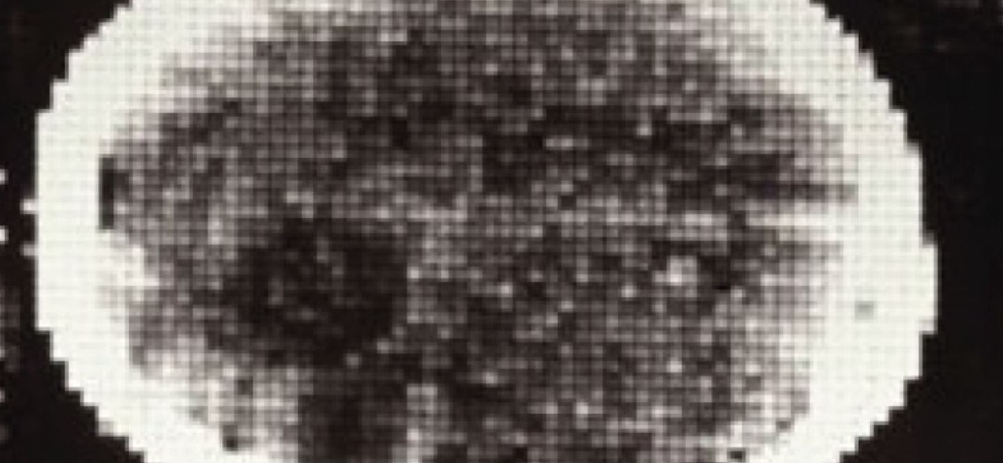 50 years ago, the first CT scan let doctors see inside a living skull ...