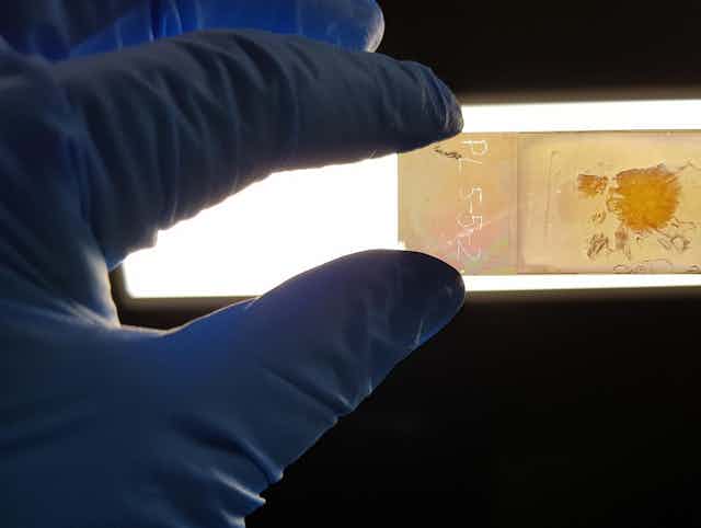 Microscope slide with cancer tissue