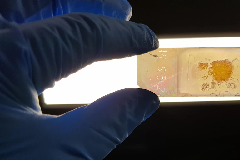 Microscope slide with cancer tissue