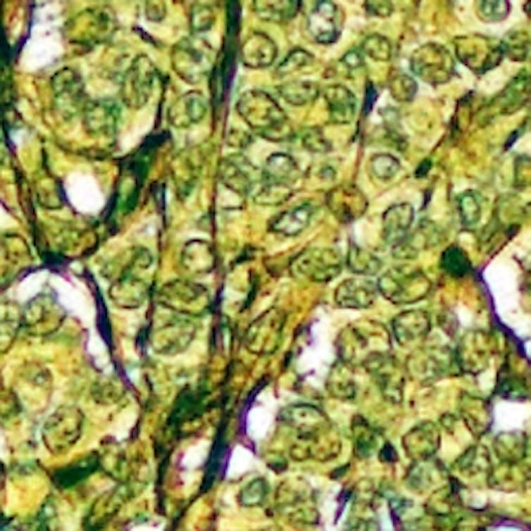 Human cancerous tissue viewed under miscroscope