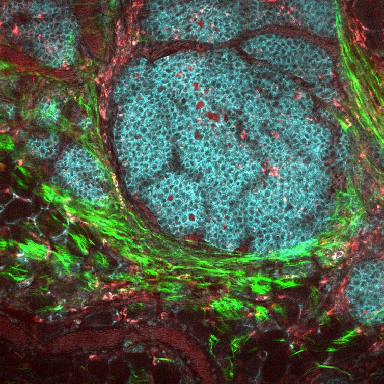 Image d’une tumeur du cancer du sein et de son microenvironnement
