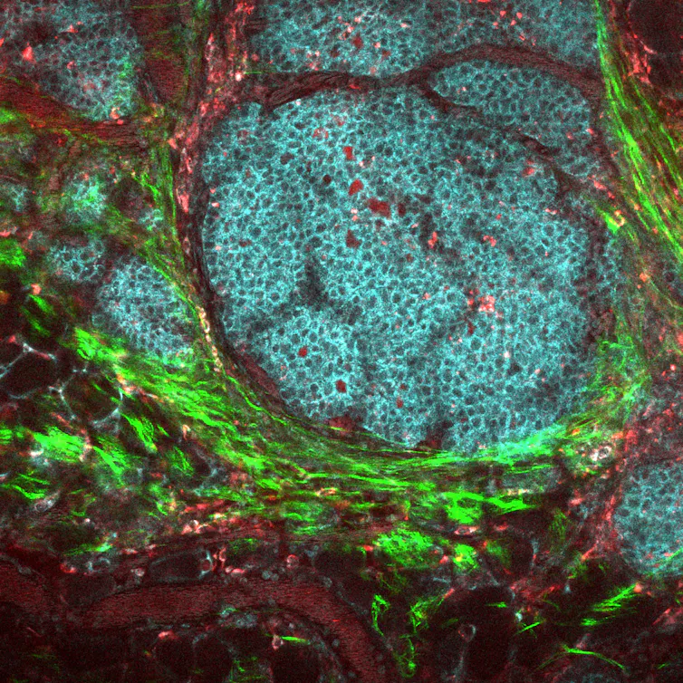 Image d’une tumeur du cancer du sein et de son microenvironnement