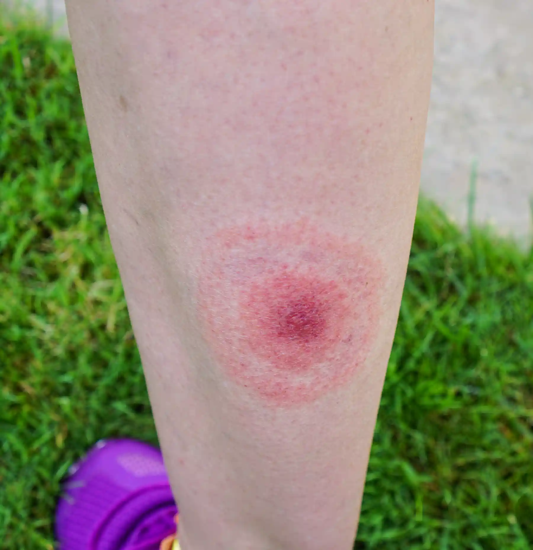 Cardiovascular Rash Lyme carditis: Things can get complicated when Lyme disease affects ...
