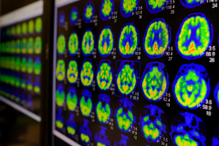PET scan of the human brain.