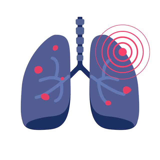 Illustration of lungs with red spots on the lobes, one of which has red circles radiating outwards like a target.