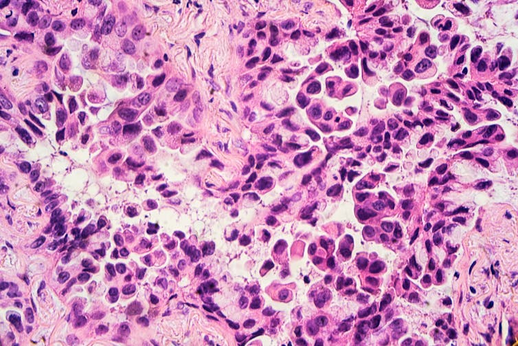 Pathology slide of lung adenocarcinoma.