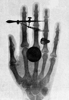 Wilhelm Roentgen's x-ray of his wife's hand