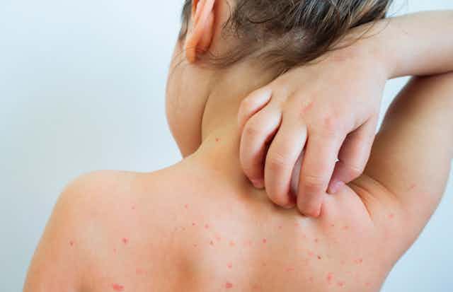 A young girl with chickenpox scratches her back.