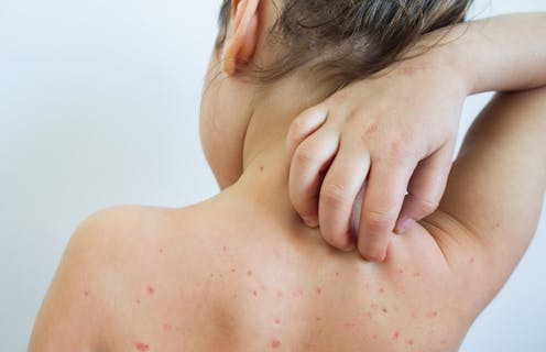 The chickenpox virus has a fascinating evolutionary history that continues to affect peoples' health today