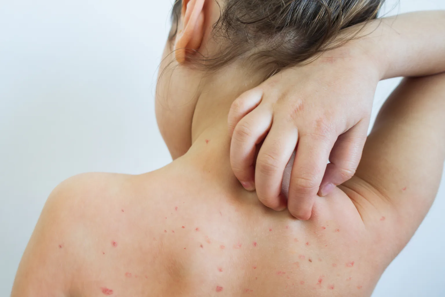 Recent Chickenpox The chickenpox virus has a fascinating evolutionary history that ...