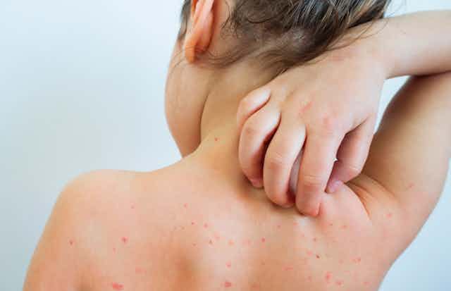 Chickenpox, Smallpox और Mpox, तीनों के बीच में क्या अंतर है? 4 Chickenpox, Smallpox