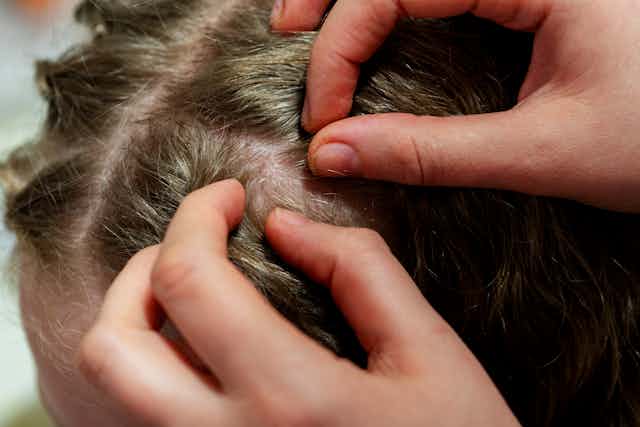 Tratamiento de piojos en el pelo y cómo eliminar las liendres.