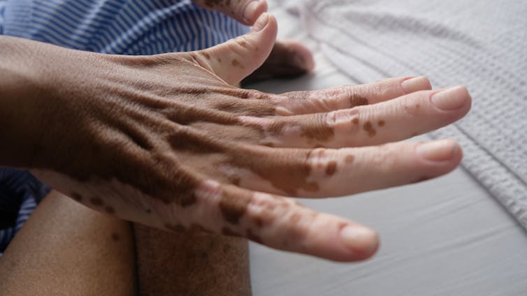A hand with vitiligo showing an absence of melanin on the fingers