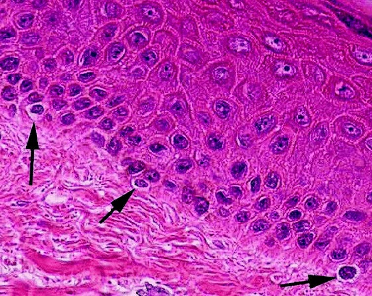 Micrograph of melanocytes in the epidermis.