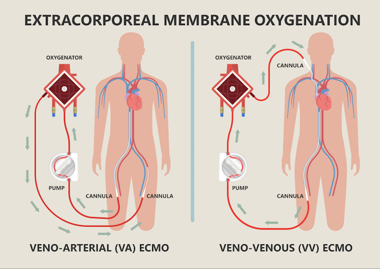 diagram of blood pumping ECMO machine