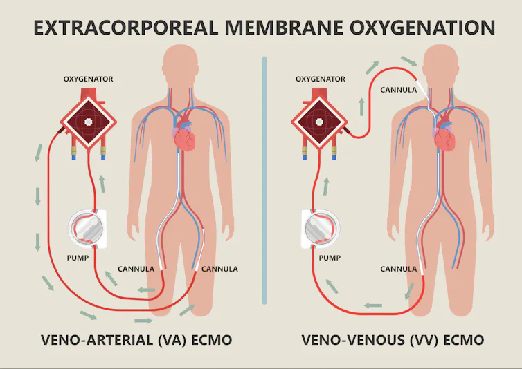 diagram of blood pumping ECMO machine