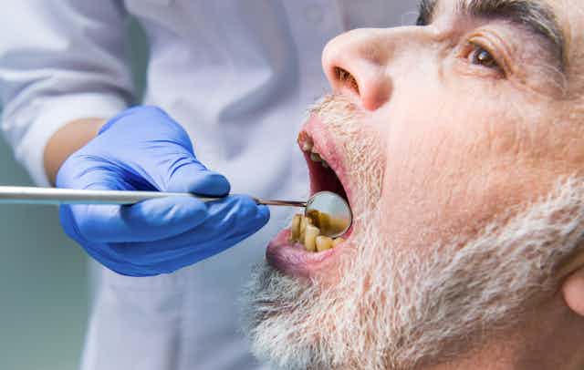 A man with yellowing teeth having a dental check-up