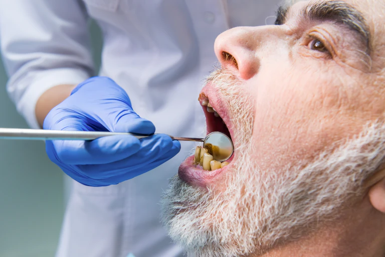 A man with yellowing teeth having a dental check-up