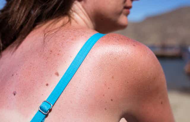 When on beach with sunburnt shoulder