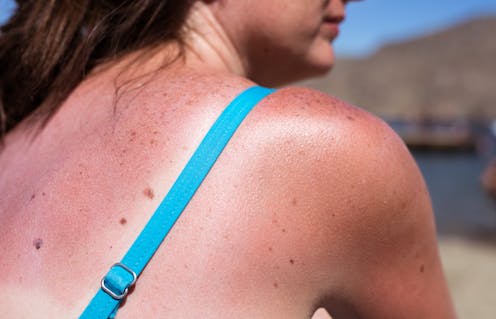 Drugs and the sun – your daily medications could put you at greater risk of sunburn