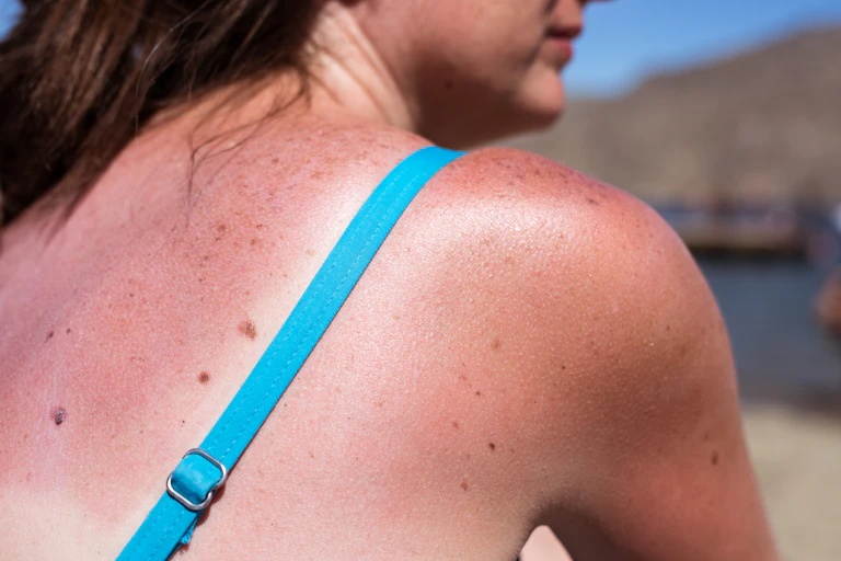 When on beach with sunburnt shoulder