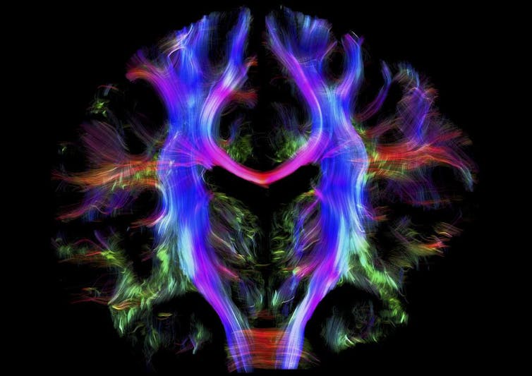 Cerveau par IRM