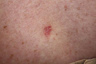 skin carcinomas linked to increased risk of other cancers
