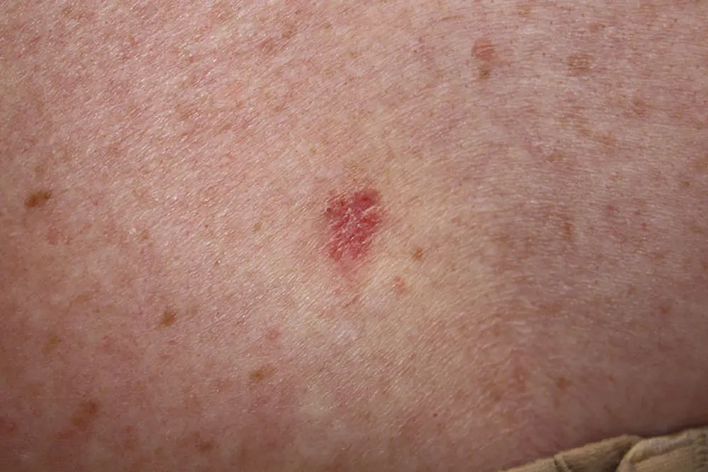 Skin carcinomas linked to increased risk of other cancers Skin carcinomas linked to increased risk of other cancers