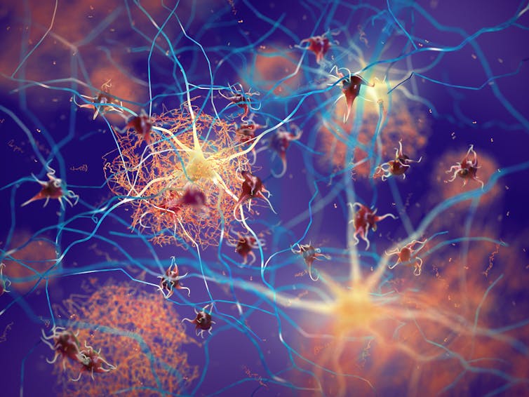 A digital depiction of amyloid plaques that form between neurons in the brain.
