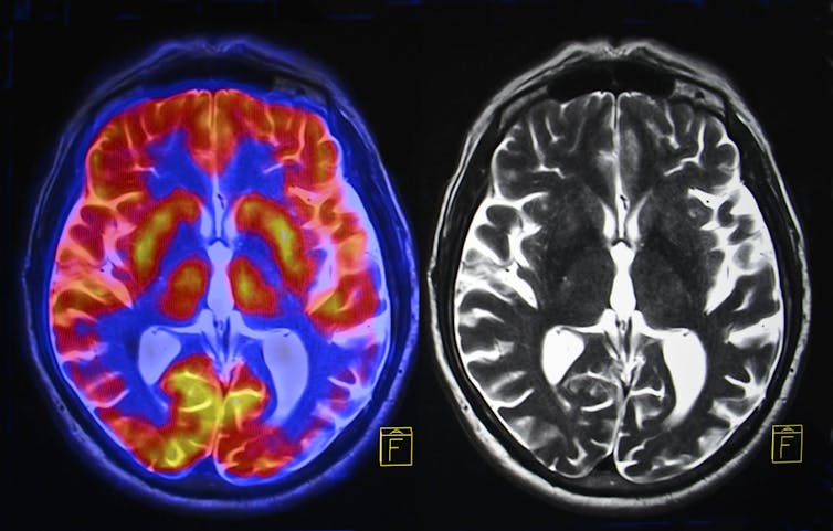 Εικόνα μιας μαγνητικής τομογραφίας εγκεφάλου.