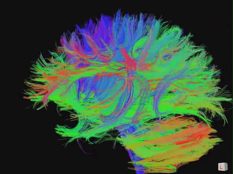 Tractography scan showing brain axons.