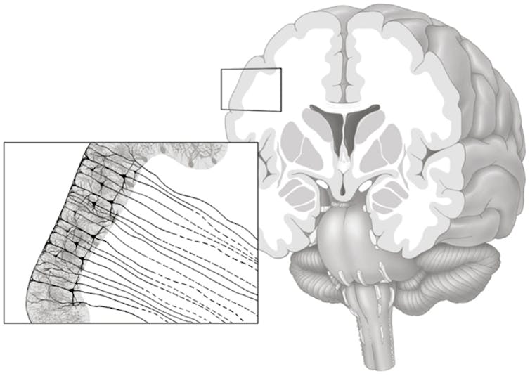 Illustration of cross section of brain showing axonal pathways transitioning from gray matter into white matter.