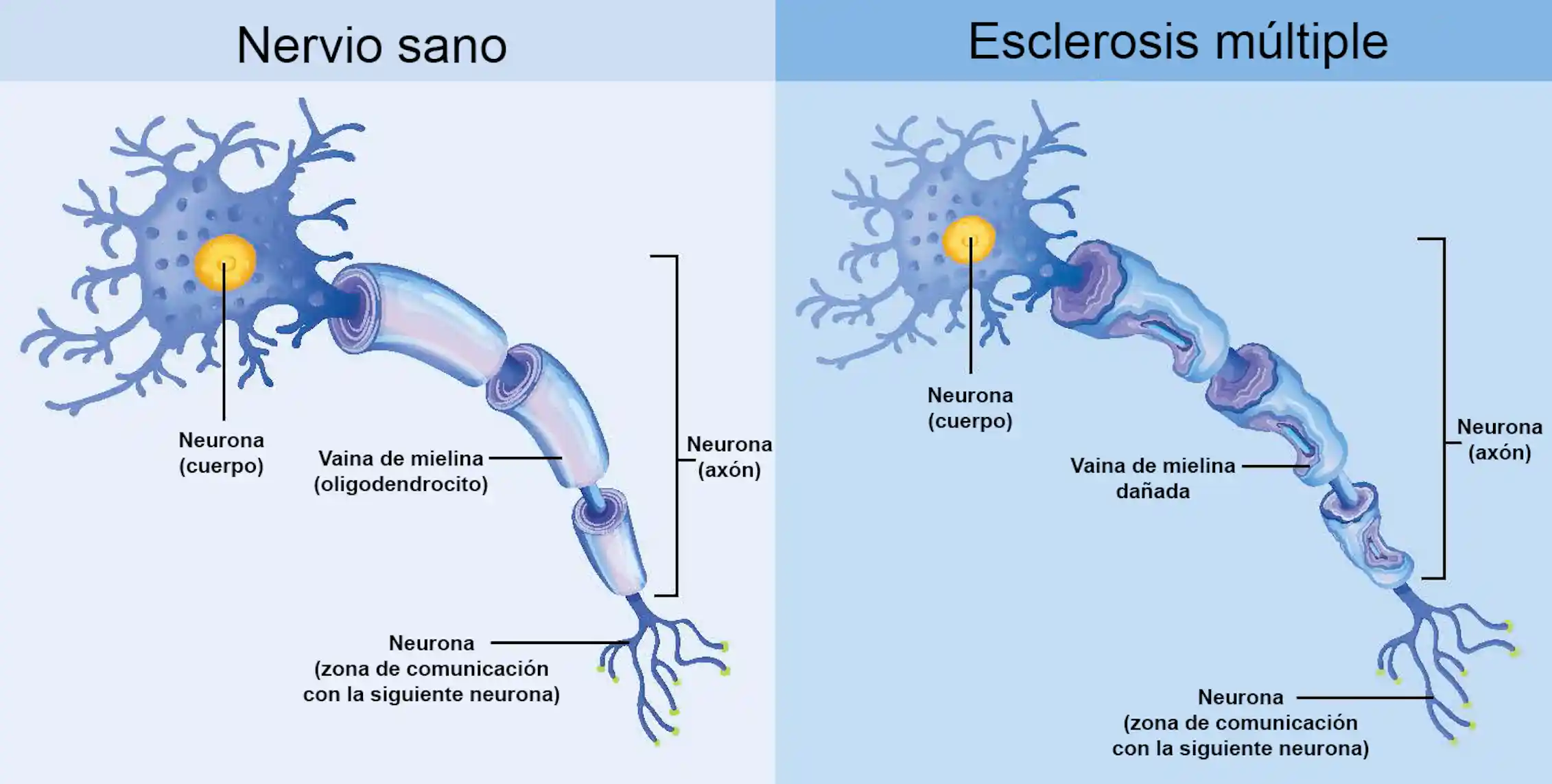 Esclerosis múltiple: así ‘mordisquea’ el sistema inmunitario nuestra ...