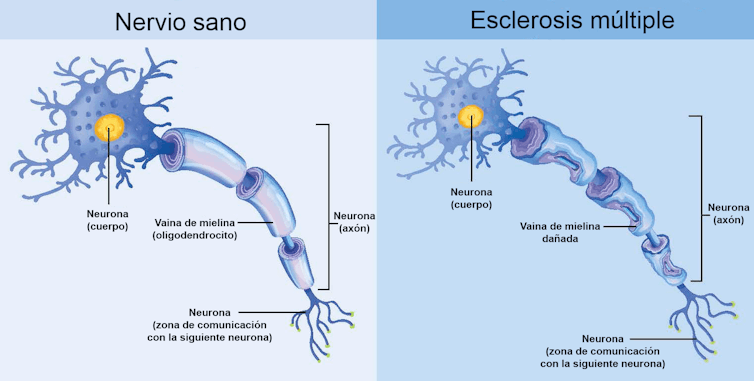 esclerosis mielina
