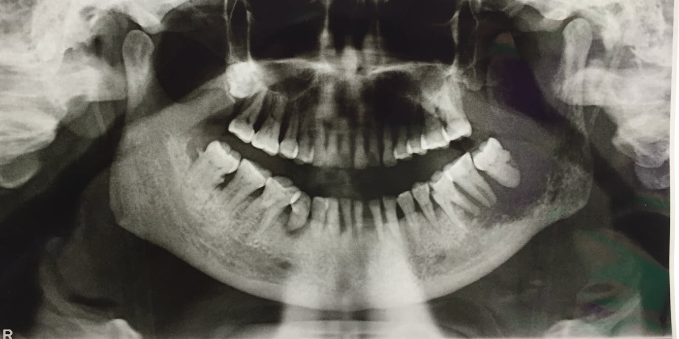 Остеогенная саркома челюсти мрт