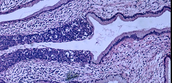 Virus del papiloma biopsia Cancerul la gât: simptome, virusul HPV, tratament