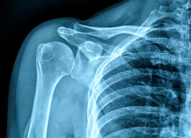 Photo of an x-ray of a human shoulder