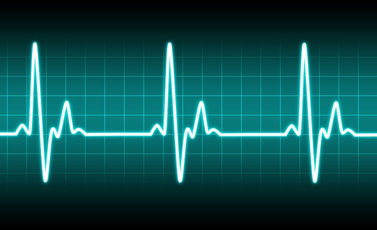 Digital image of a heartbeat, as shown on an electrocardiogram (ECG).