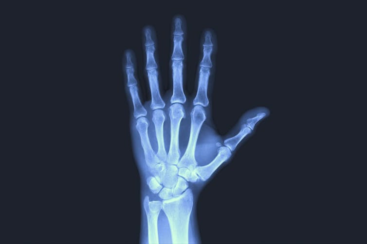 An x-ray of a hand