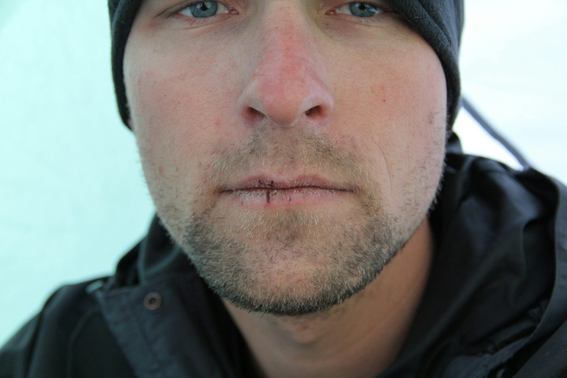 Lèvres Gercées : Comment Expliquer Cette Plaie Hivernale (Et S'en  Débarrasser)