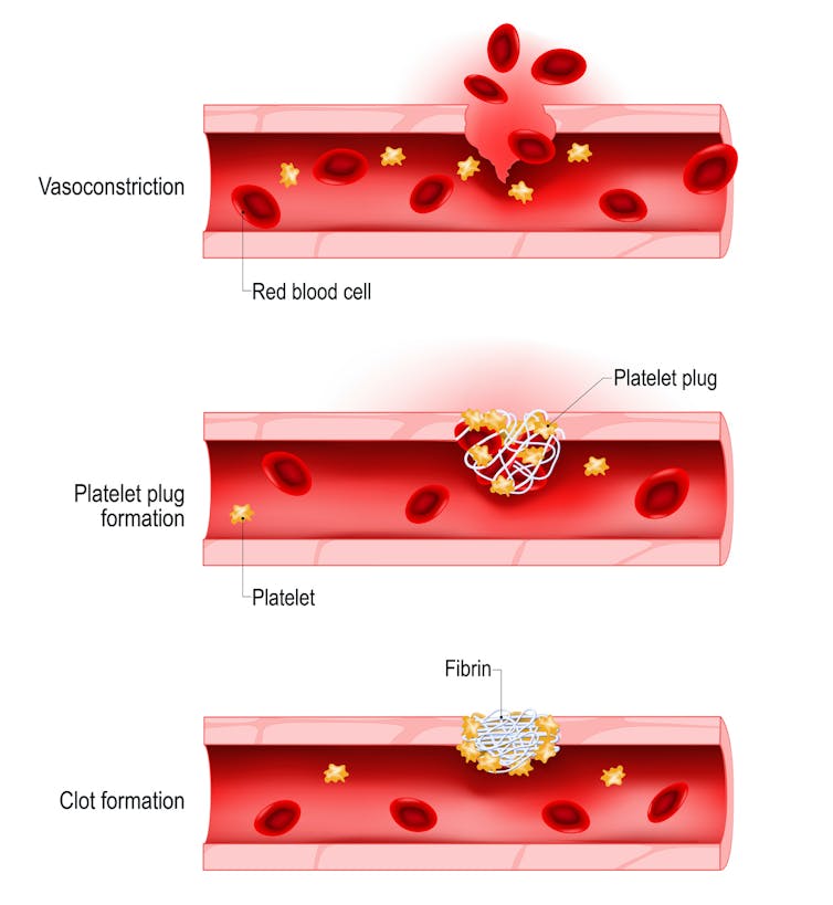 Diagram showing process of platelet and fibrin clumping to close a wound to a blood vessel.
