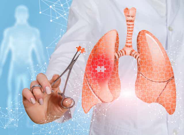 Illustration of lungs with a jigsaw pattern, and a person in a white coat holding a puzzle piece in medical forceps