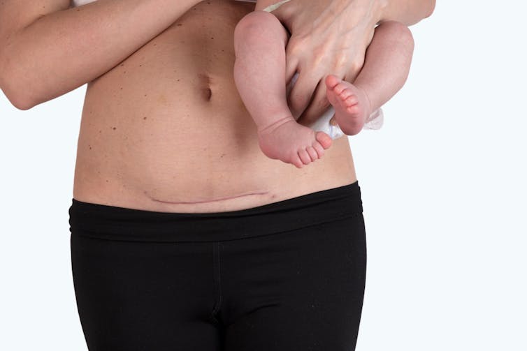 woman with caesar scar holds baby