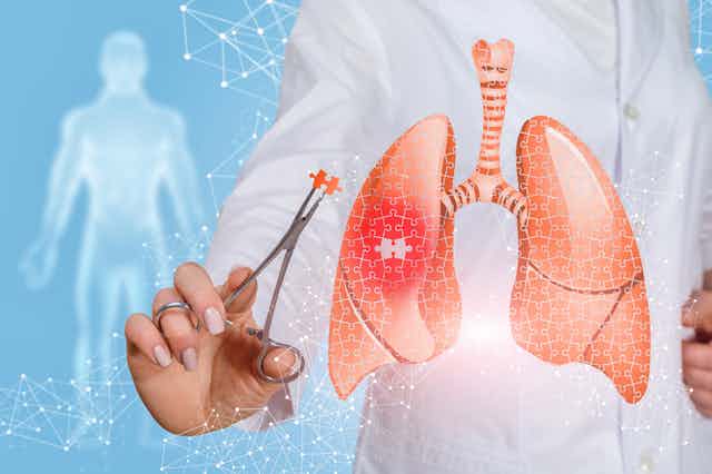 Illustration de poumons avec un motif de puzzle, et d'une personne en blouse blanche tenant une pièce de puzzle dans une pince médicale.