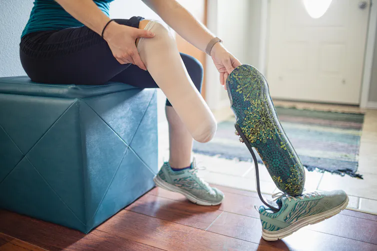Person putting on prosthetic leg